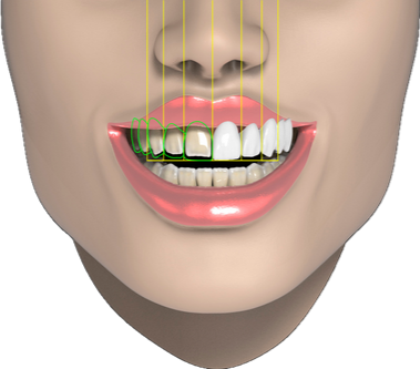 Digital smile design